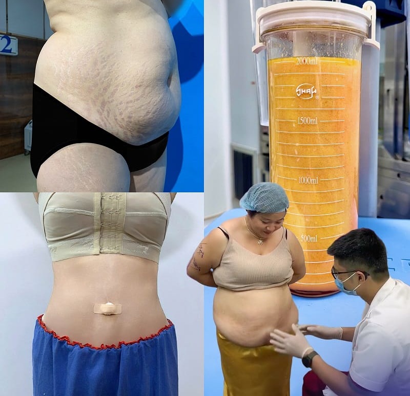 Bác sĩ tiến hành kiểm tra tình trạng vùng da hút mỡ để đảm bảo an toàn hút mỡ lại lần sau 