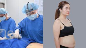 Hút mỡ là gì? Cơ chế hoạt động, độ an toàn và những điều cần biết