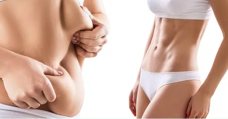 Hút mỡ lần 2 hồi phục sau 3-6 tháng khi các mô mềm bên dưới phẳng mịn và sự co hồi da