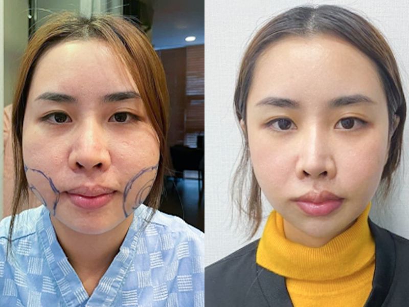 Bản đồ các vùng mỡ khu trú phù hợp nhất cho hút mỡ gây tê bao gồm má, nọng cằm