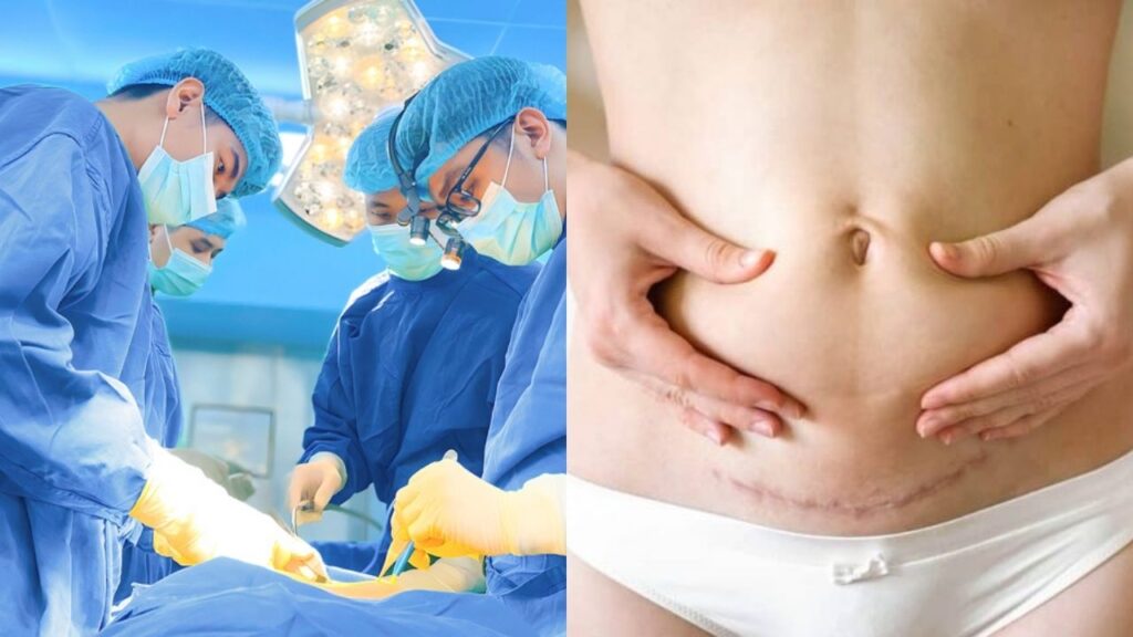 Hút mỡ sau sinh có an toàn không? Lộ trình hồi phục chuẩn y khoa cho mẹ bỉm 2026