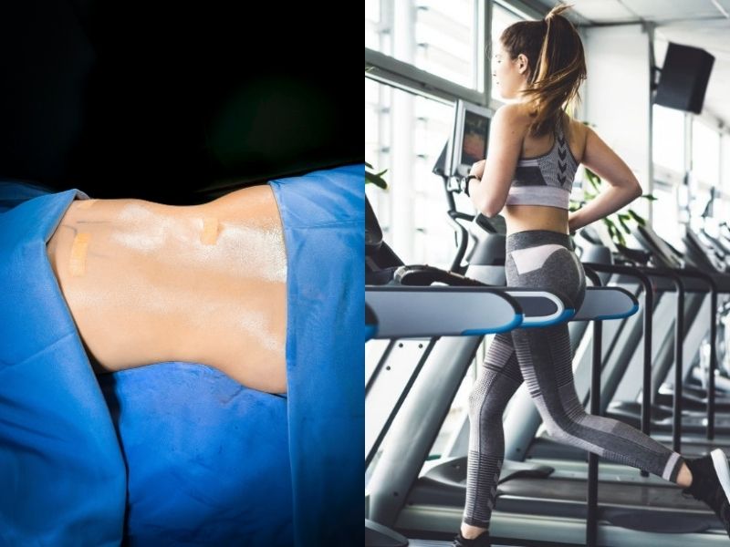 Sự khác biệt giữa hút mỡ và tập luyện thể dục giảm cân