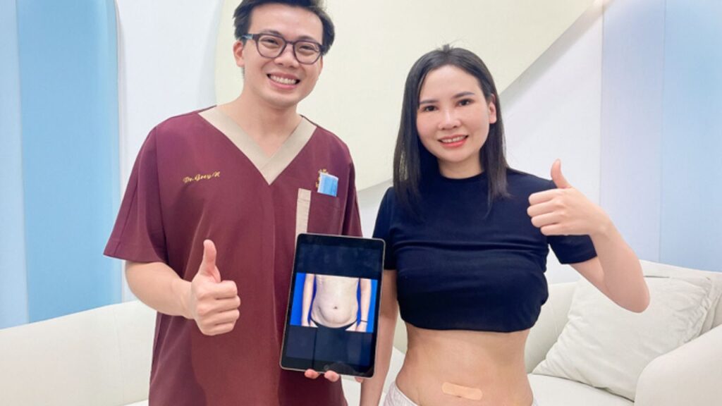 Hút mỡ bao lâu thì hết phù nề? Bí quyết rút ngắn thời gian sưng bầm sau 7 ngày