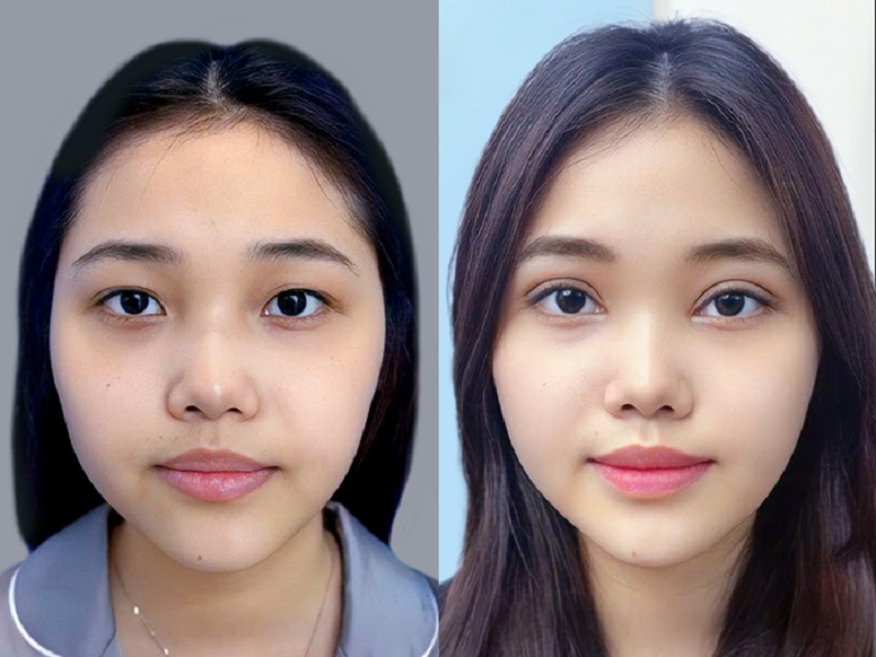 Chọn cắt mí Plasma khi nếp mí gặp tình trạng sụp mí, nếp mí ẩn