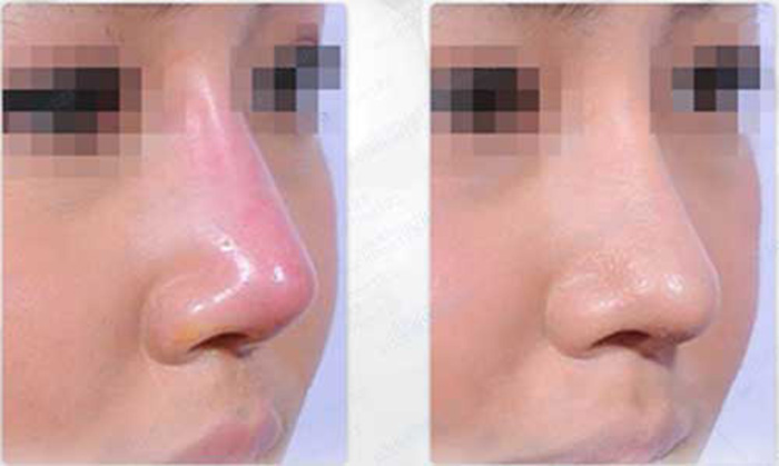 Lộ sống, bóng đỏ mỏng dần theo thời gian, có thể nhìn thấy rõ hình dáng sụn bên trong