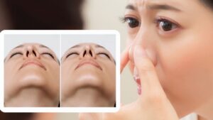 Khi nào cần sửa mũi? Dấu hiệu bắt buộc chỉnh sửa và thời điểm sửa mũi an toàn nhất