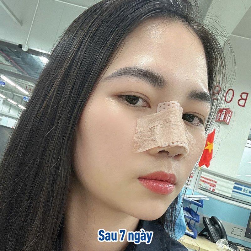 Tái khám sau 7 ngày để kiểm tra và cắt chỉ mũi giúp hạn chế sẹo và biến chứng nguy hiểm