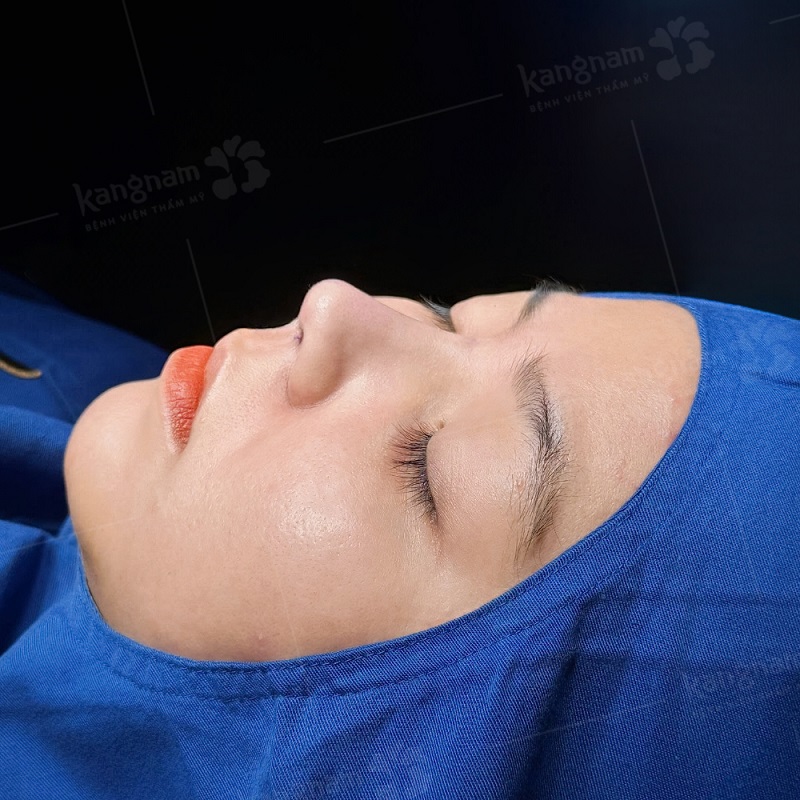 Kỹ thuật dựng trụ mũi bằng sụn vách ngăn trong nâng mũi cấu trúc giúp chống tụt dáng mũi bền hơn bọc sụn thông thường.