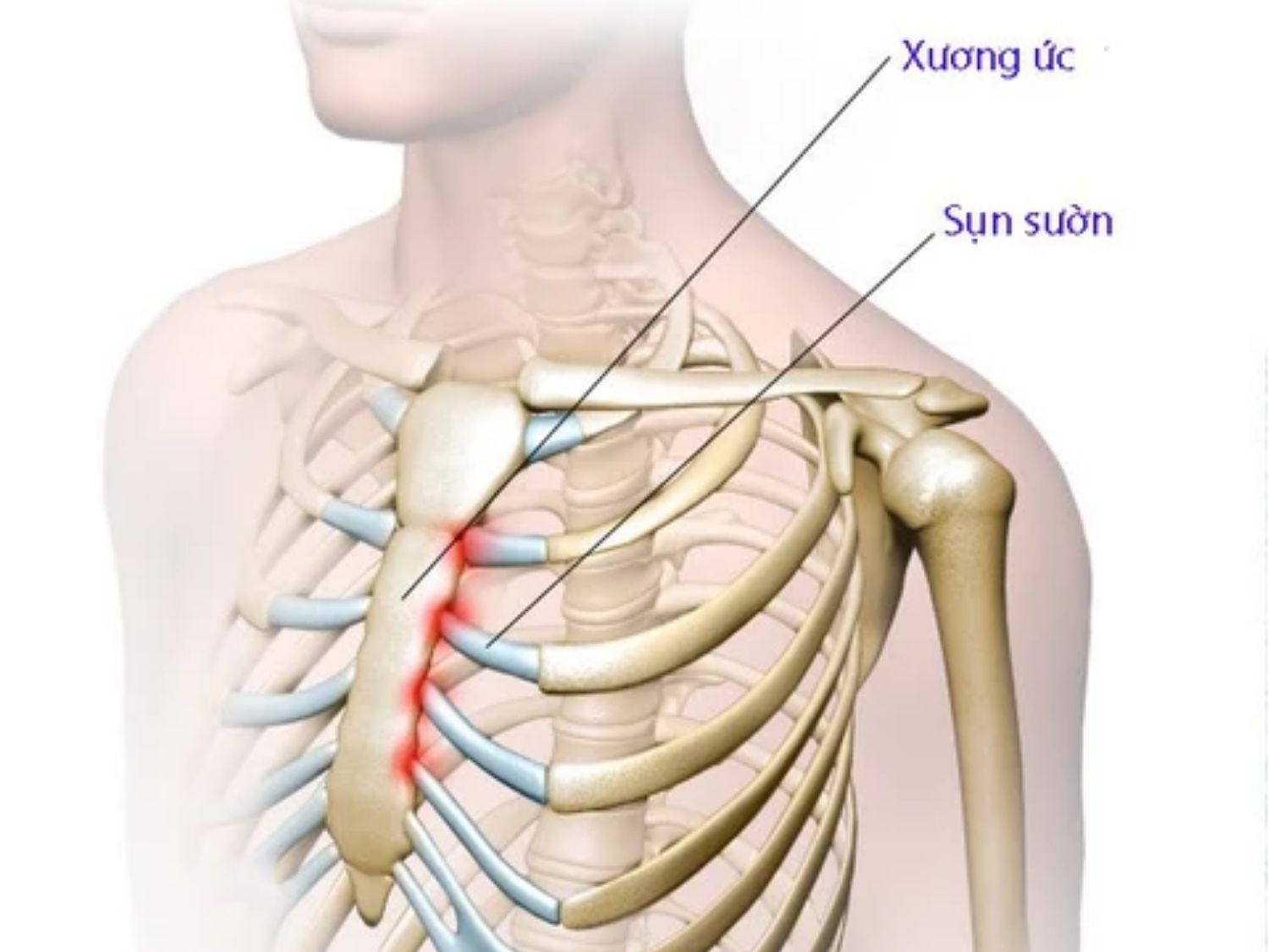 ảnh minh họa vị trí lấy sụn sườn nâng mũi, thường lấy ở xương sườn số 6,7,8