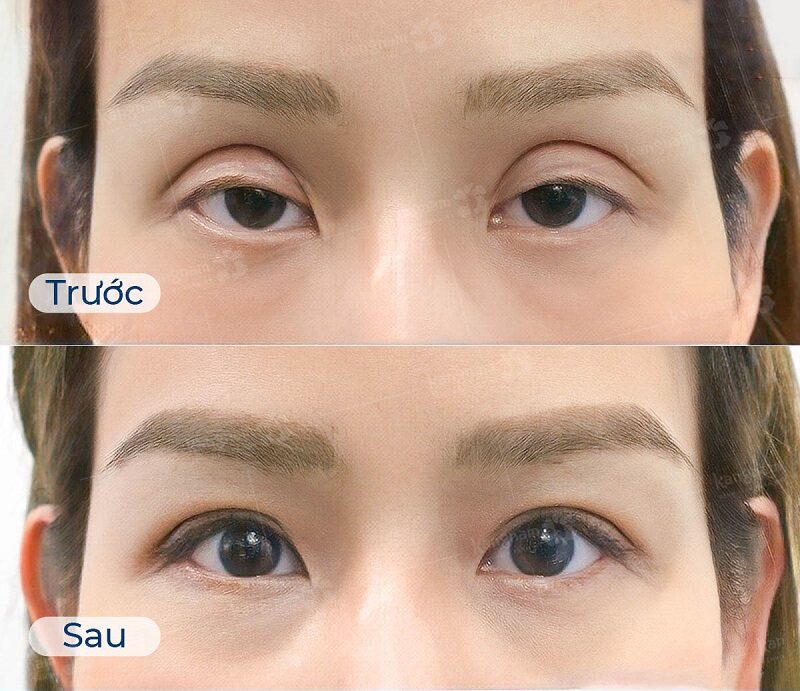 Hình ảnh khách hàng trước và sau khi khắc phục trợn mí