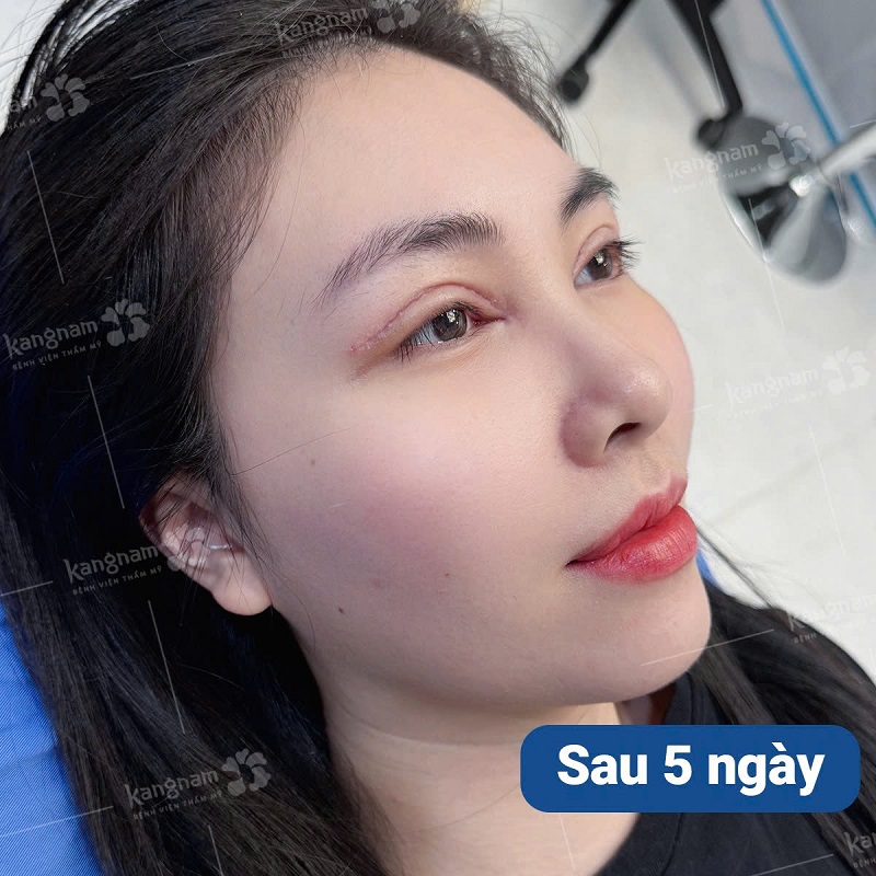 Sau khoảng 5 ngày mí mắt đã giảm sưng rõ rệt