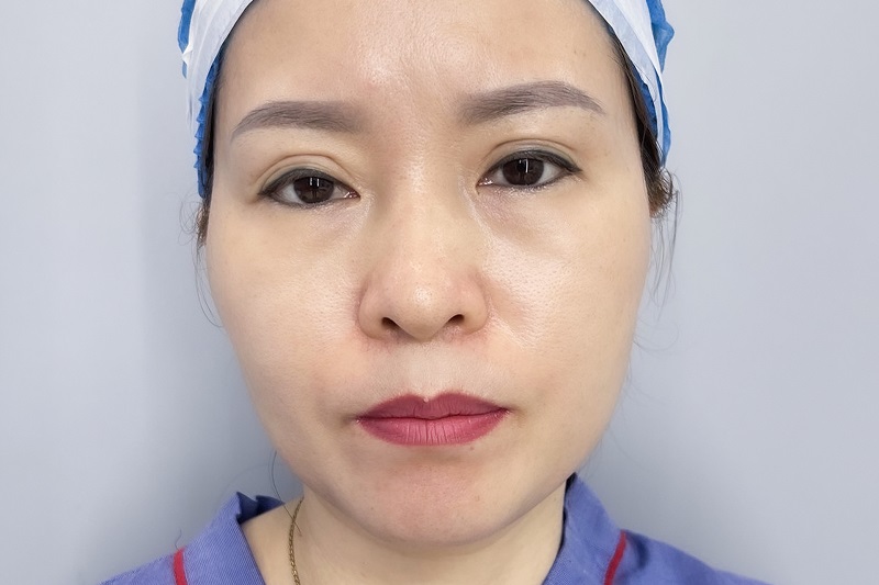 Mí mắt bị lệch, mất cân đối sau cắt mí