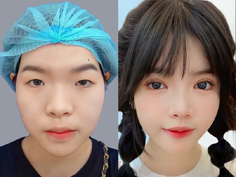 Kết quả nếp mí mắt đẹp tự nhiên không để lại sẹo sau 3 tháng phục hồi hoàn toàn