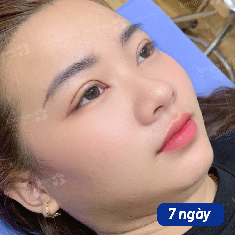 Những ngày đầu cắt mí, nếp mí vẫn sưng tấy, chưa đều