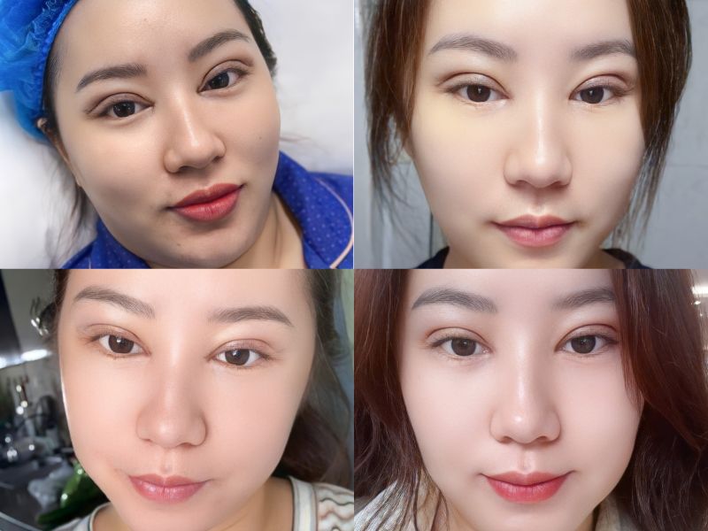 Nếp mí sau cắt hồi phục theo từng giai đoạn từ hơi sưng đau đến hoàn toàn lành, mờ sẹo và trông tự nhiên nhất