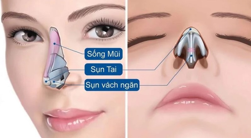 Mô phỏng cấu trúc mũi bền vững bao gồm độ cao sống mũi và sự liên kết chặt chẽ giữa sụn vách ngăn với mô mềm.