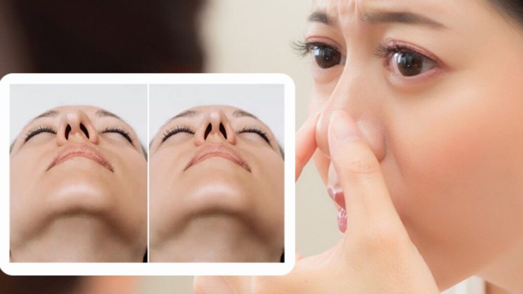 Mũi bị lệch sau nâng: Cách phân biệt Lệch giả do sưng và Lệch thật cần sửa lại