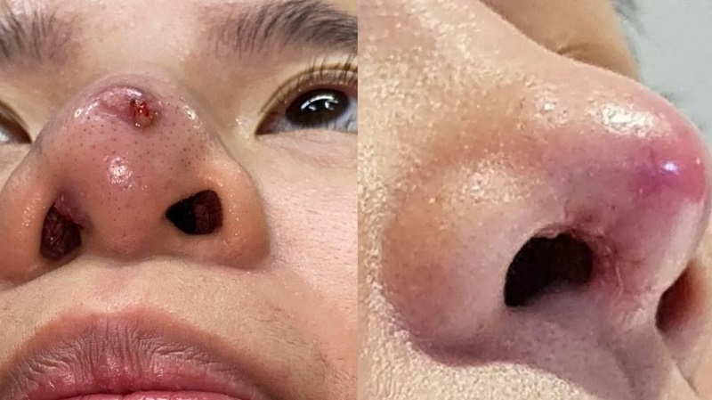 Dáng mũi biến chứng bóng đỏ lộ sóng do đặt sụn quá cao hoặc da mũi mỏng.