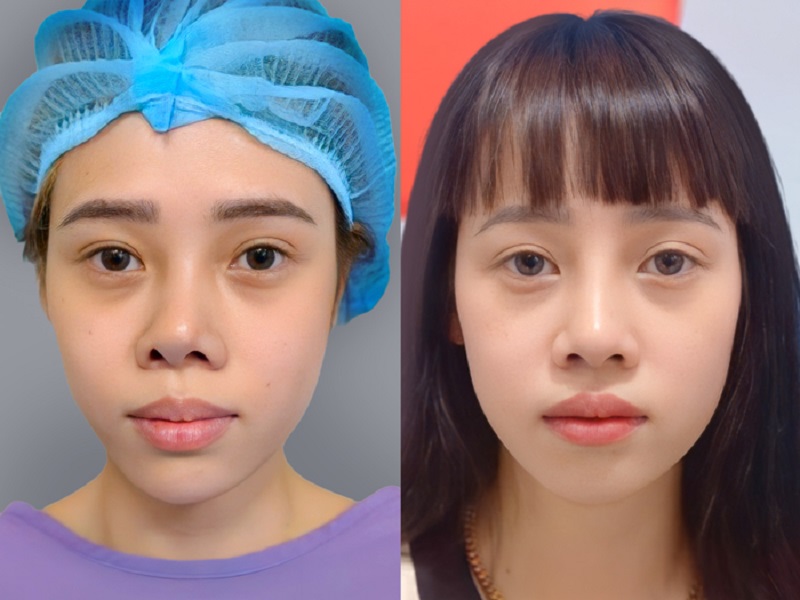 Chỉnh sửa mũi viêm giúp giảm thiểu nguy cơ hoại tử mũi