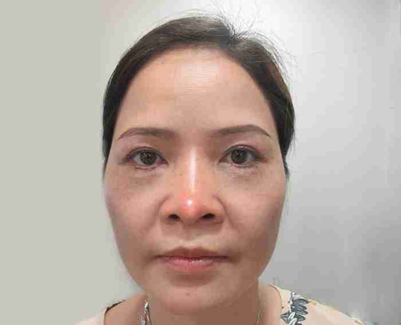 Mũi đỏ sau nâng là phản ứng viêm sau phẫu thuật do da mũi mỏng