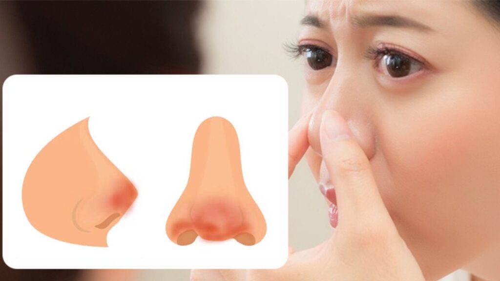 Mũi đỏ đau sau nâng có nguy hiểm không? Dấu hiệu cần theo dõi