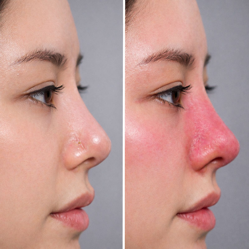 Dấu hiệu nâng mũi bị viêm nhiễm trùng sau thẩm mỹ mũi