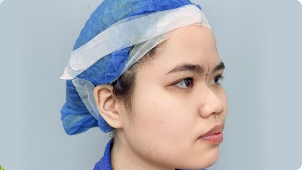 Mũi hếch nên nâng mũi thế nào để hết lộ lỗ mũi, dáng mũi đẹp tự nhiên?