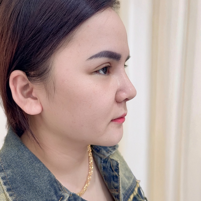 Nâng mũi cấu trúc tạo dáng mũi thon gọn, tự nhiên