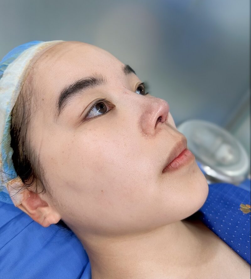 Dáng mũi ngay sau khi nâng, có độ cao rõ nét hơn