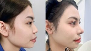 Mũi sau hồi phục trông như thế nào? Lộ trình 6 tháng biến hình chuẩn y khoa