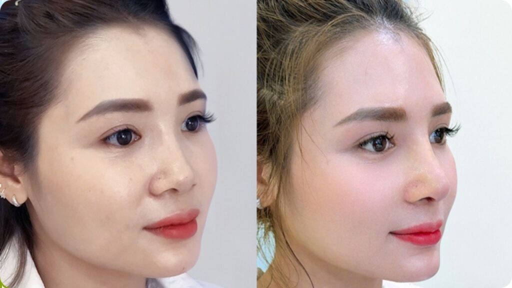 Mũi thấp nên nâng mũi thế nào cho đẹp? Bí quyết sở hữu dáng mũi vạn người mê