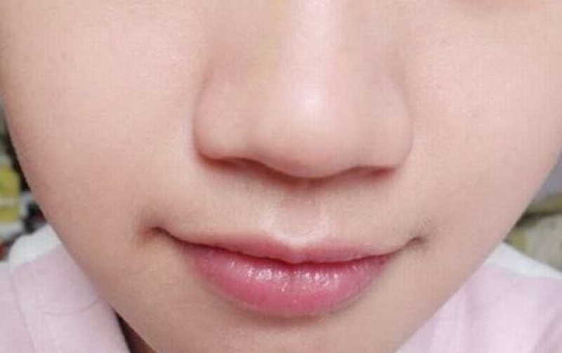 Mũi to có cánh mũi bè, nhìn tổng thể khuôn mặt không hài hòa cả khi nhìn thẳng và nhìn nghiêng