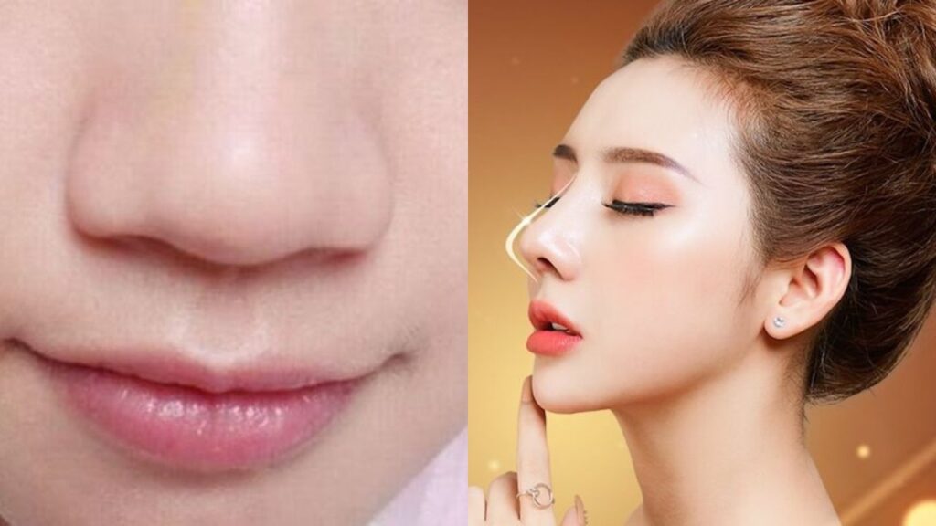 Mũi to nên nâng mũi không? Khi nào chỉ nâng là đủ, khi nào cần thu gọn?