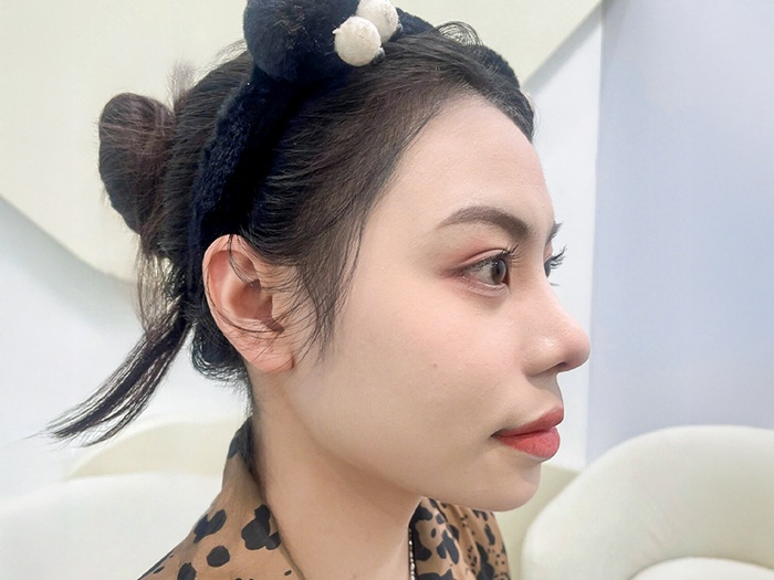 Nâng mũi cấu trúc giúp dáng mũi thon gọn, cao và hài hòa với đường nét khuôn mặt