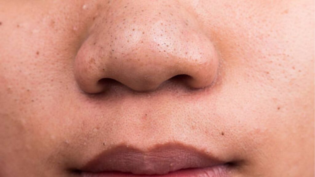 Mũi to nên nâng mũi không? Khi nào chỉ nâng là đủ, khi nào cần thu gọn?