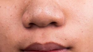 Mũi to nên nâng mũi không? Khi nào chỉ nâng là đủ, khi nào cần thu gọn?