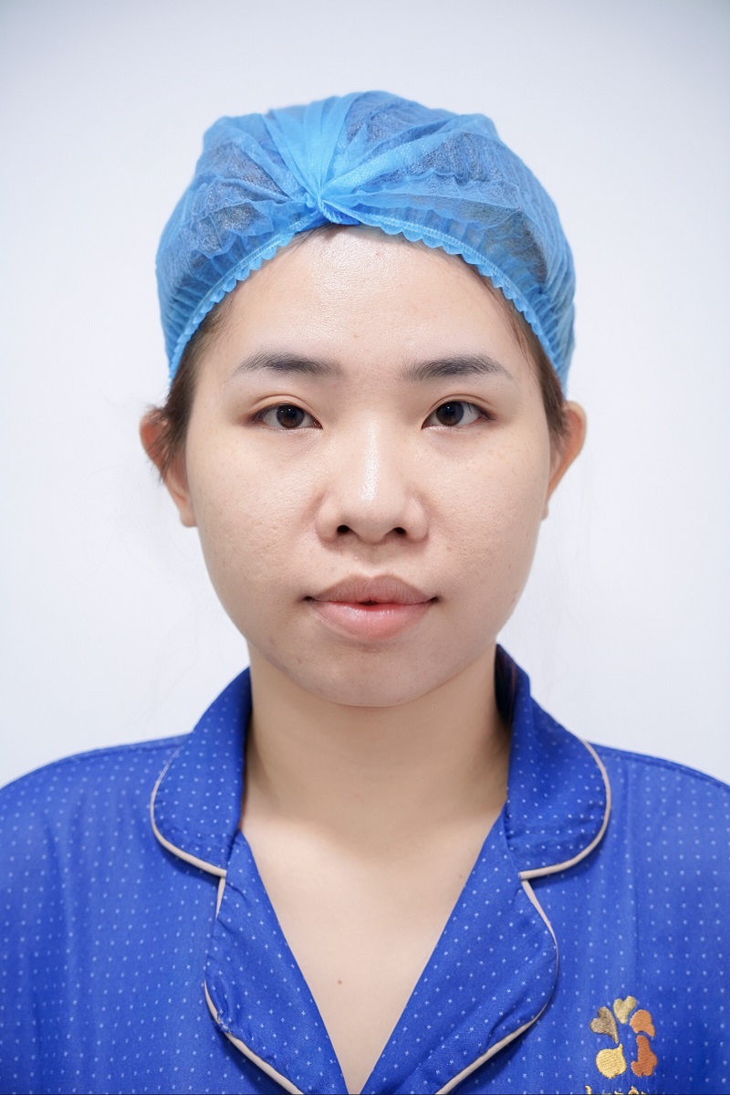 Thanh Hằng gặp tình trạng mũi thấp, đầu mũi tù