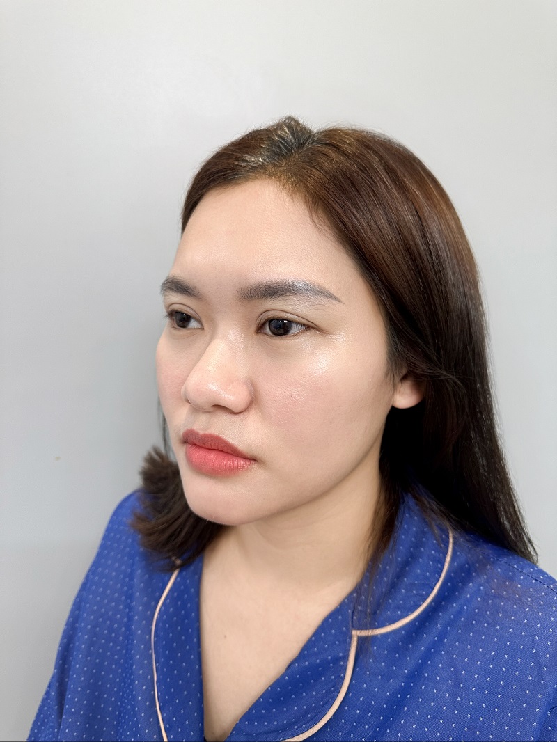 Khách hàng Phương Hằng trước khi nâng mũi cấu trúc Nanoform tại Kangnam