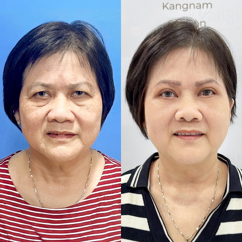 Treo cung mày kéo cao phần chân mày bị sụp