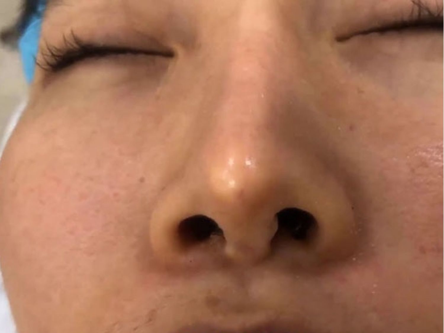 Mũi gồ ghề, lộ sụn là dấu hiệu không bình thường, cần kiểm tra sớm