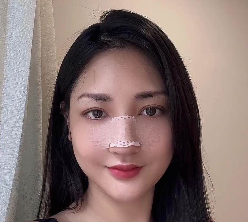 Mũi thường sưng và đau nhất trong ngày đầu tiên sau khi nâng