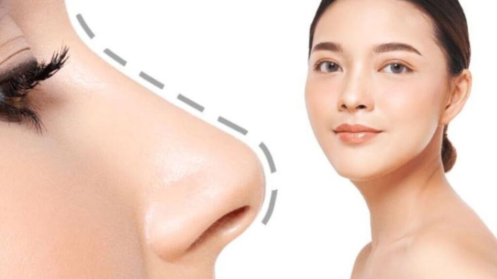 Nâng mũi bao lâu thì hết sưng? Mốc thời gian hồi phục & dấu hiệu sưng bất thường cần lưu ý