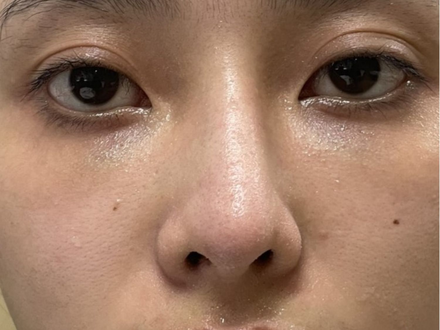 hình ảnh tình trạng mũi lệch do chăm sóc sai cách và không tuân thủ lịch tái khám từ bác sĩ