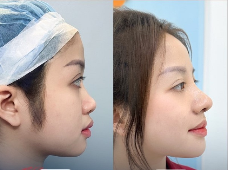 Cơ địa tốt giúp mũi nhanh phục hồi chỉ sau vài ngày