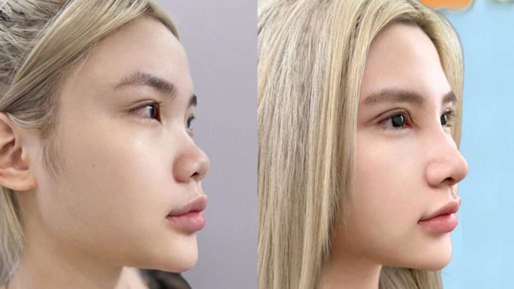 Nâng mũi bao lâu thì lành? Lộ trình 5 giai đoạn hồi phục chuẩn y khoa 2026