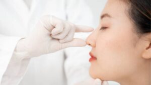 Nâng mũi bao lâu thì ổn định? Mốc thời gian vào form và mềm tự nhiên theo từng phương pháp