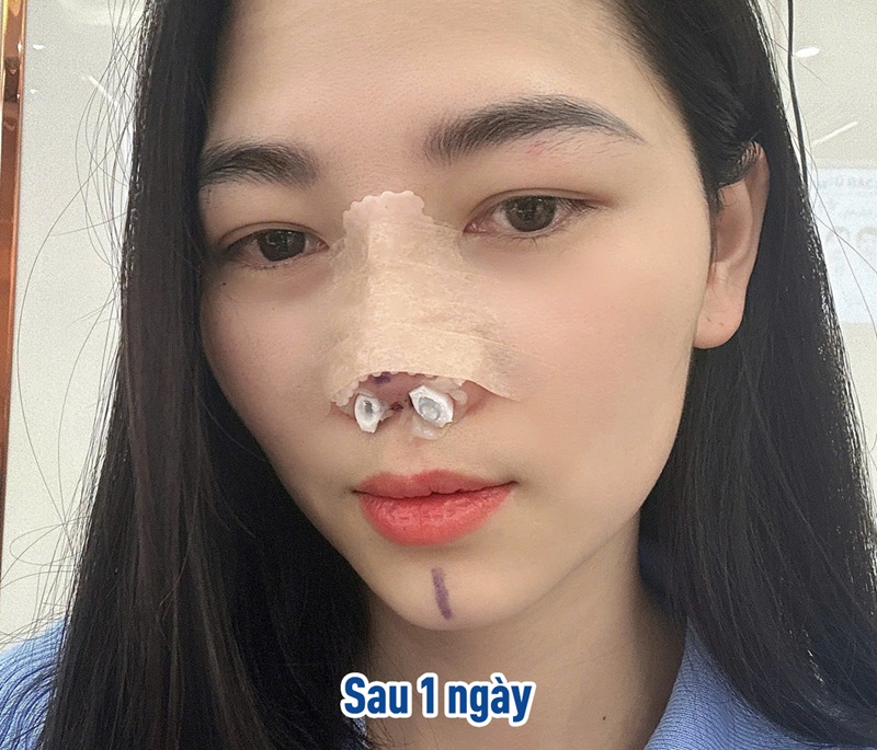 Từ 1–3 ngày đầu, cơn đau ở mức đỉnh điểm sau nâng mũi