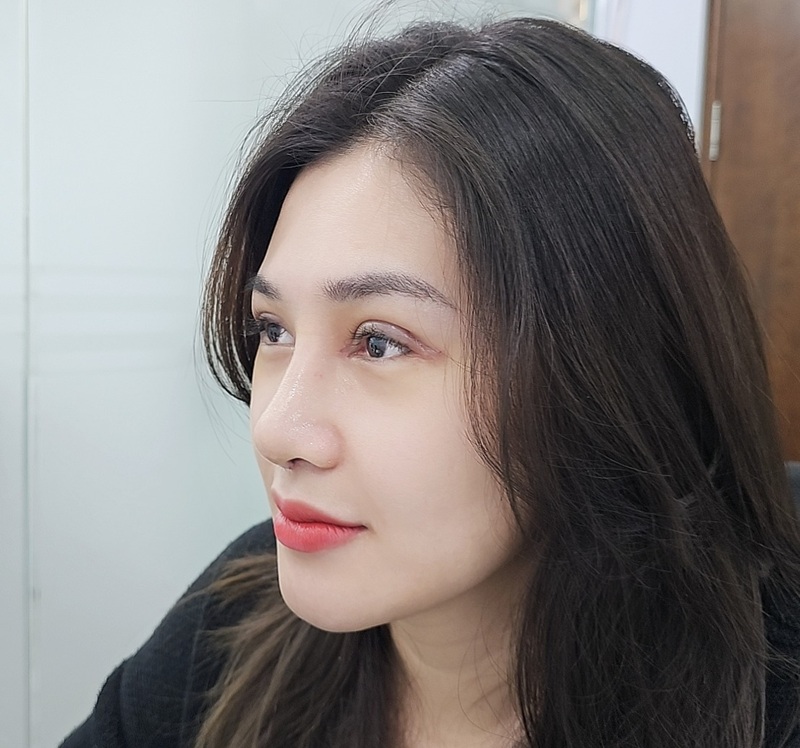 Nâng mũi bị đau nhức có sao không? 5 dấu hiệu cảnh báo biến chứng cần biết