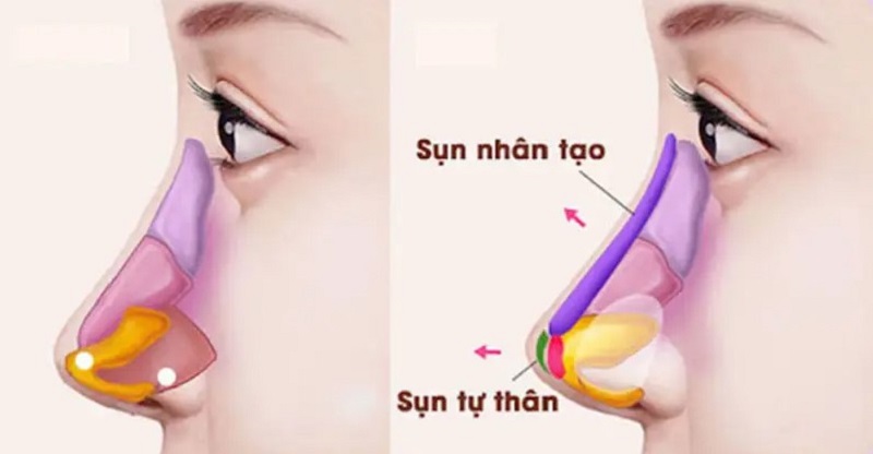 So đồ mô phỏng kỹ thuật nâng mũi cấu trúc can thiệp vách ngăn trụ mũi và đầu mũi