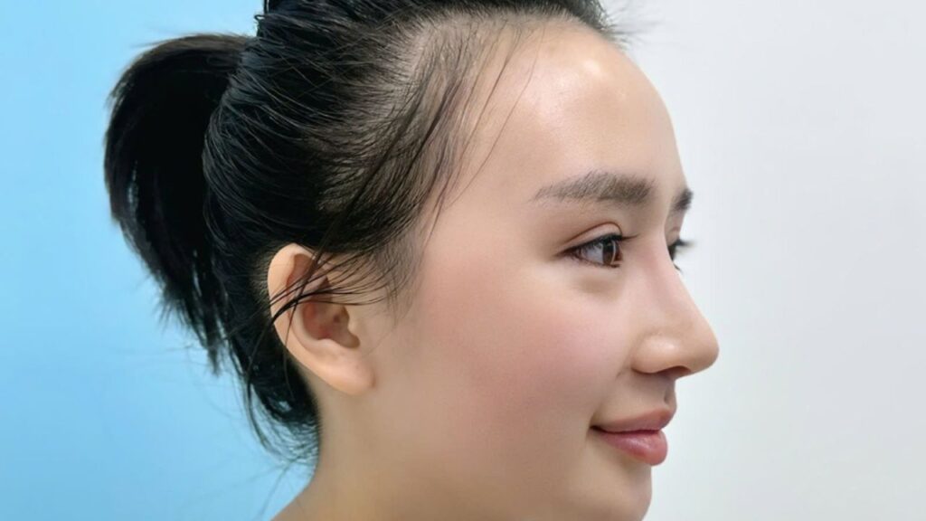 Nâng mũi cấu trúc hay bọc sụn tốt hơn? So sánh 6 tiêu chí chọn lọc